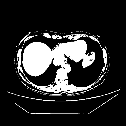 Original VENOUS CT scan