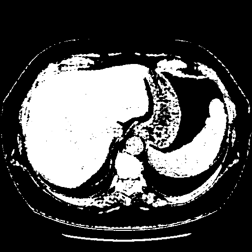 Original VENOUS CT scan