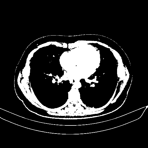 Original VENOUS CT scan