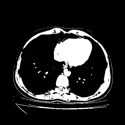 Original VENOUS CT scan