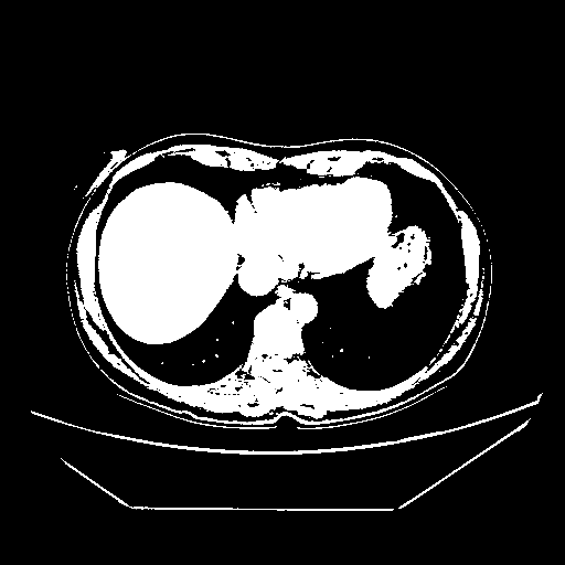 Original VENOUS CT scan
