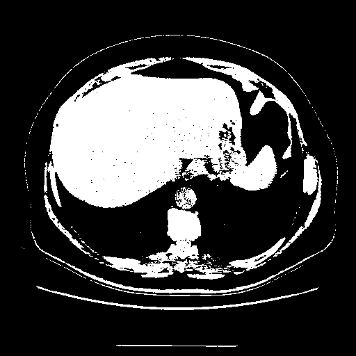 Original NATIVE CT scan (input)