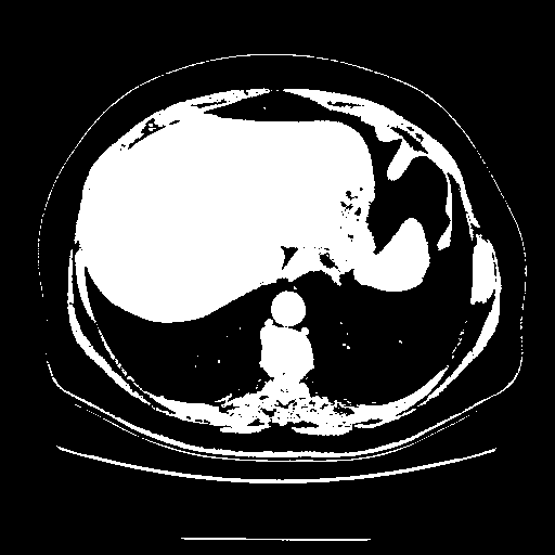 Original VENOUS CT scan