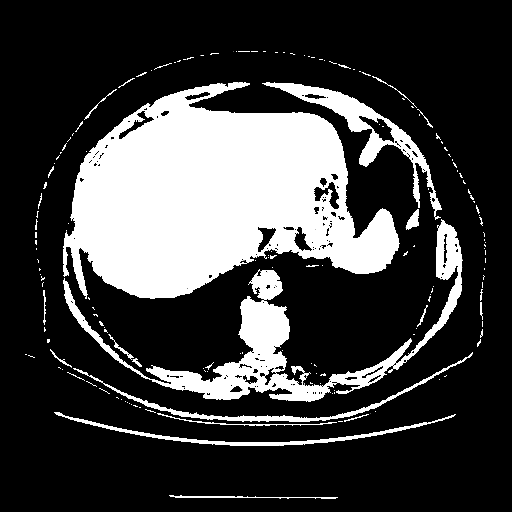 Reconstructed NATIVE CT scan (cycle consistency)