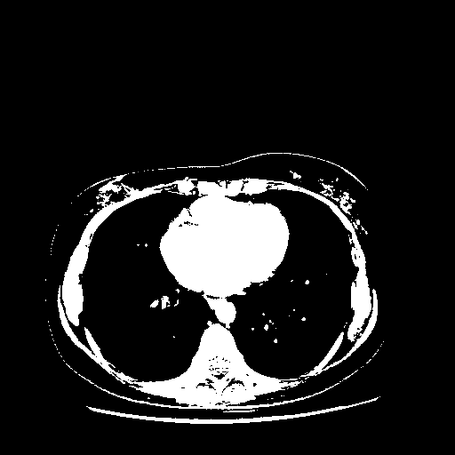 Original VENOUS CT scan