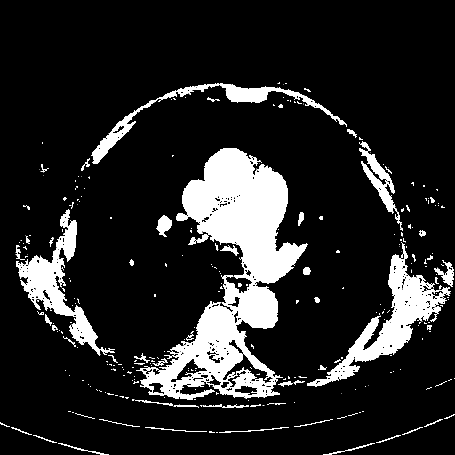 Original VENOUS CT scan