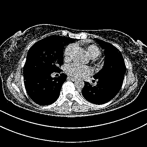 Original NATIVE CT scan (input)