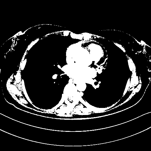 Original VENOUS CT scan