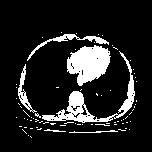 Original NATIVE CT scan (input)